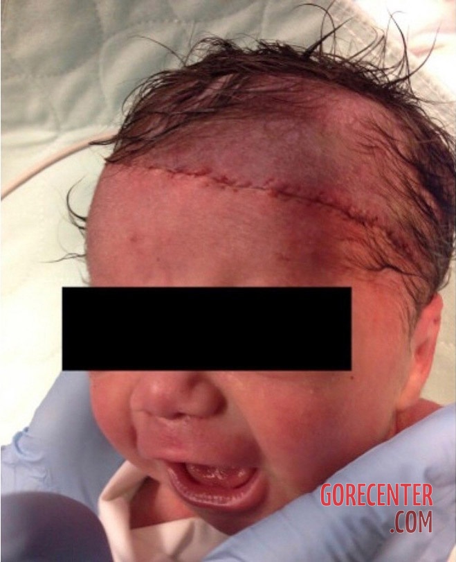 Partially-scalped-newborn-during-cesarean-delivery-1.jpeg