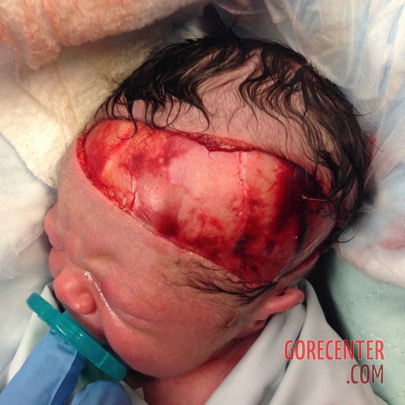 Partially-scalped-newborn-during-cesarean-delivery-2.jpeg