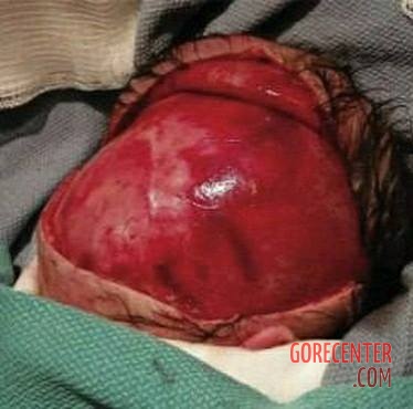 Partially-scalped-newborn-during-cesarean-delivery-3.jpeg