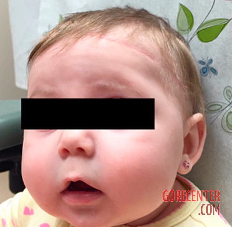 Partially-scalped-newborn-during-cesarean-delivery-4.jpeg