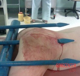 Womans-ass-impaled-by-fence-2.jpg